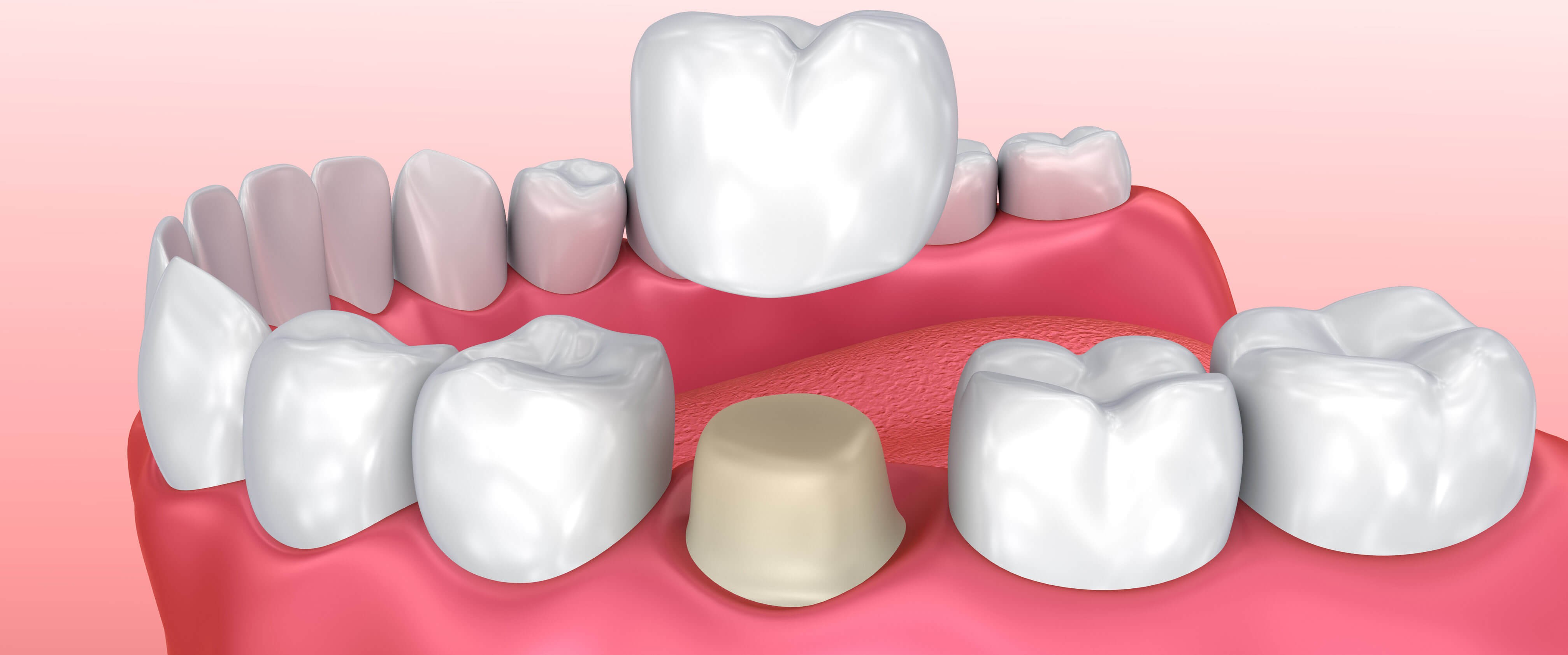 animatie ce este coroana dentara